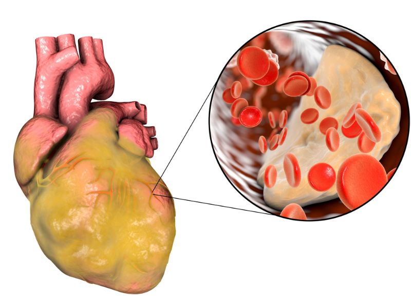 Tác hại của béo phì là bệnh tim mạch