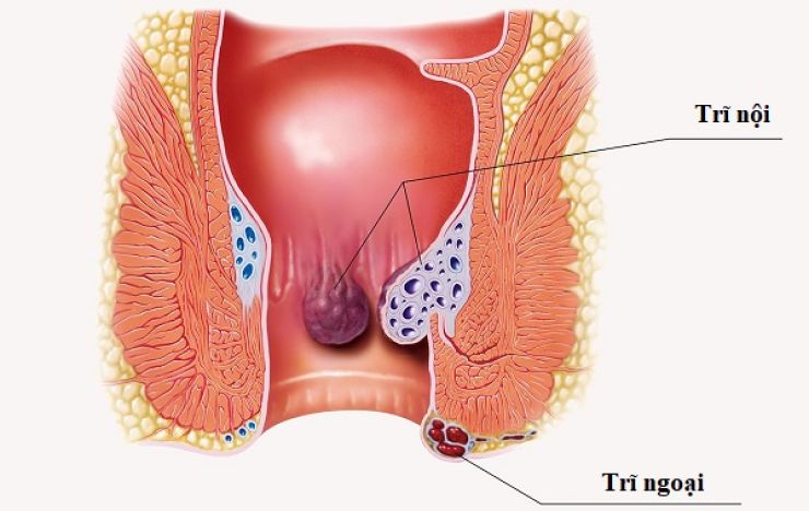 Nguyên nhân hình thành bệnh trĩ