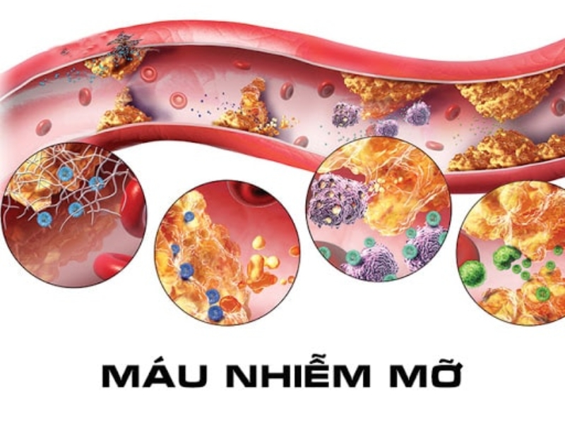 Bệnh máu nhiễm mỡ là gì?