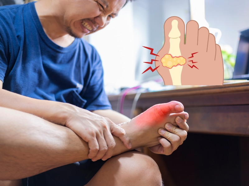 Bệnh gout và purin có liên hệ gì? 