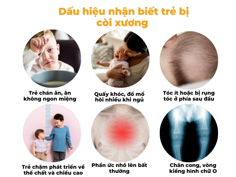 Dấu hiệu nhận biết trẻ bị còi xương