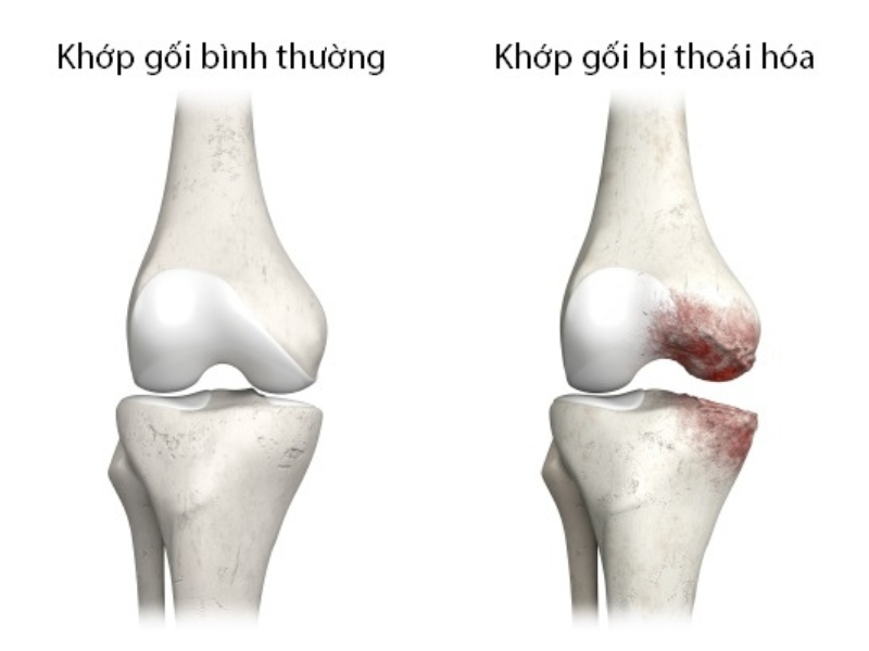 Bệnh thoái hoá khớp 