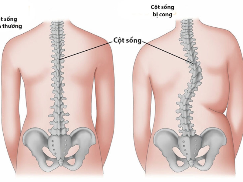 Bệnh vẹo cột sống 