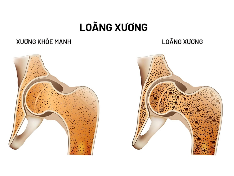 Tìm hiểu về loãng xương 