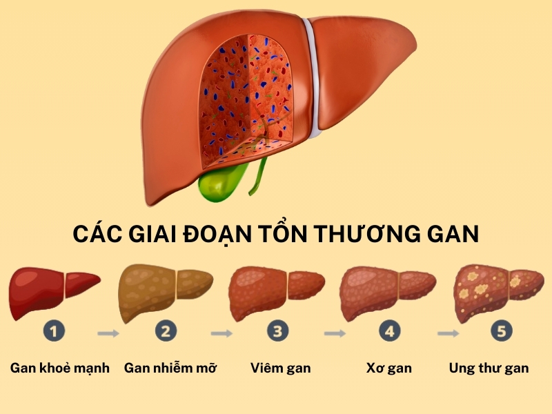 Các bệnh lý liên quan đến gan 