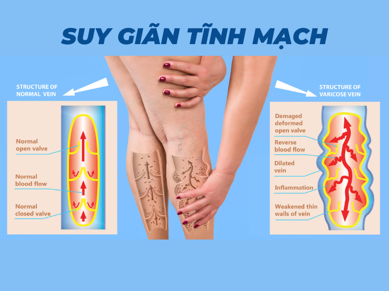 Bệnh giãn tĩnh mạch là gì?