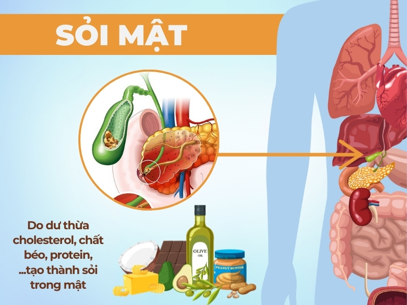 Sỏi mật 