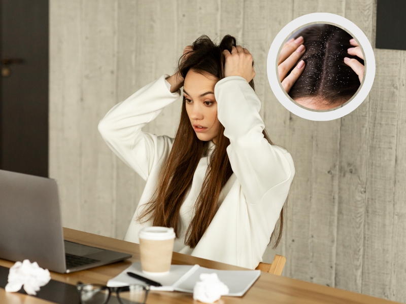 Căng thẳng, stress, thức khuya khiến tóc có nhiều gàu