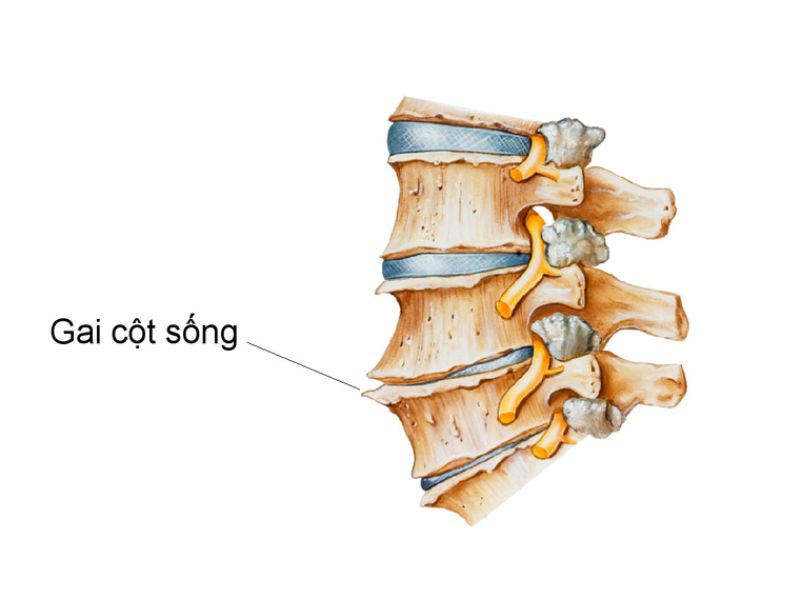 Gai cột sống